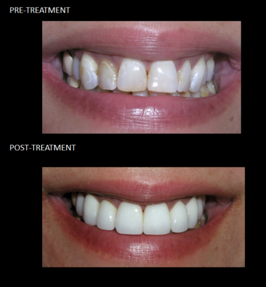 Ceramic crowns correcting her discolored enamel gave our patient confidence in her smile.