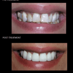Ceramic crowns correcting her discolored enamel gave our patient confidence in her smile.