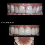 Beautiful ceramic crowns used to correct her tooth discoloration.
