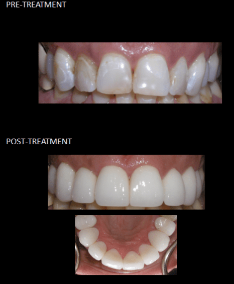 Beautiful ceramic crowns used to correct her tooth discoloration.