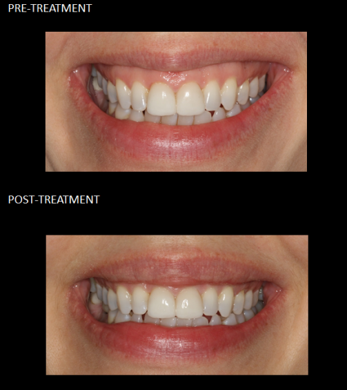 Gummy Smile before and after 3