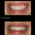 Gummy Smile before and after 3
