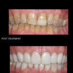 Ceramic crowns used to modify his discolored enamel.