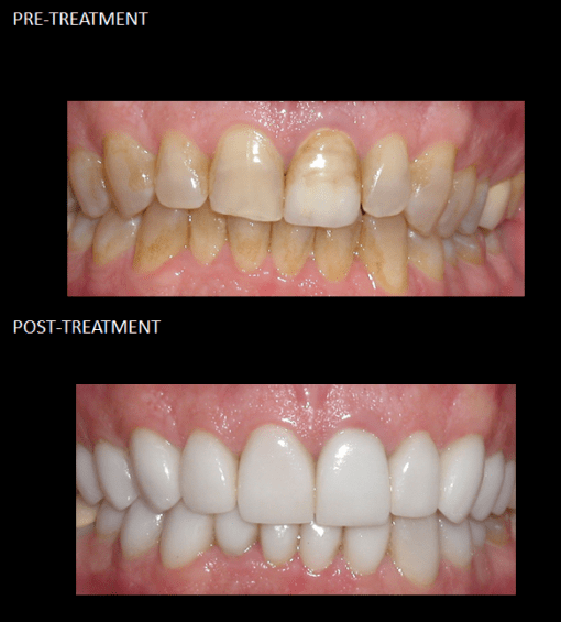 Ceramic crowns used to modify his discolored enamel.