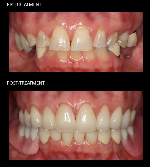 Full mouth reconstruction, with crowns and a lower implant-retained partial