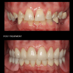 Reconstrucción de boca completa, con coronas y una parte inferior retenida por implantes