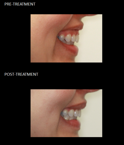 Gummy Smile before and after 2