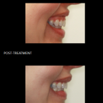 Gummy Smile before and after 2
