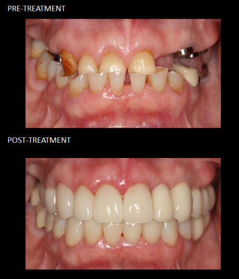 Full mouth reconstruction, crowns, implants.