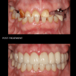Full mouth reconstruction, crowns, implants.