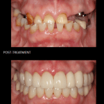 Full mouth reconstruction, crowns, implants.