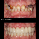 Reconstrucción de boca completa, coronas, implantes.