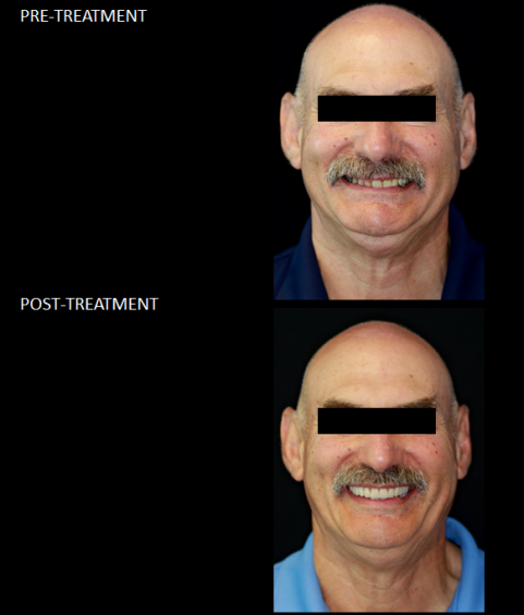 Upper denture with lower “teeth-in-a-day” implant bridge