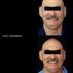 Upper denture with lower “teeth-in-a-day” implant bridge