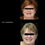 Full mouth reconstruction, with crowns and implants.