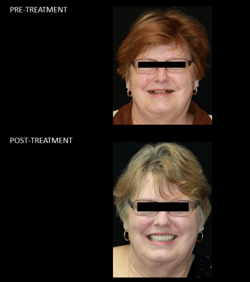 Full mouth reconstruction, with crowns and implants.