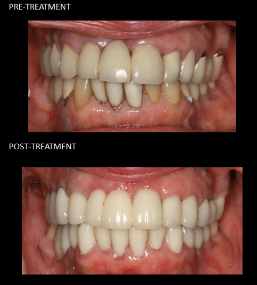 Full mouth reconstruction using ceramic crowns on teeth and implants.