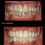 Full mouth reconstruction using ceramic crowns on teeth and implants.