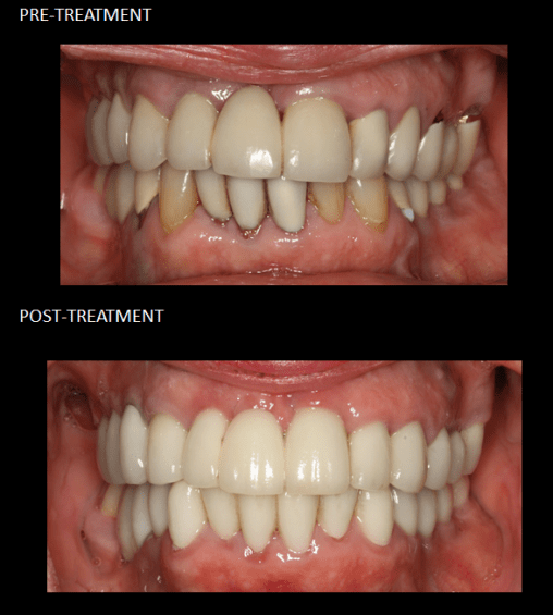 Reconstrucción bucal completa con coronas de cerámica sobre dientes e implantes..