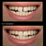 Cosmetic Bonding closing a space between our patient’s front teeth.