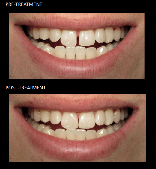 Cosmetic Bonding closing a space between our patient’s front teeth.
