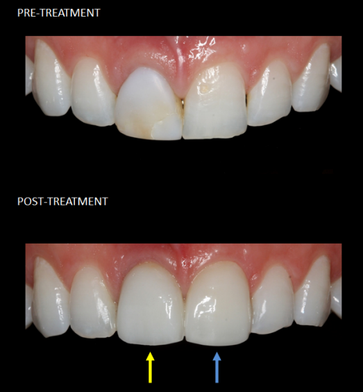 Front teeth restored with a single implant (yellow) and a matching veneer (blue).