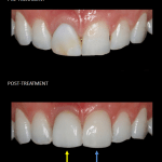 Front teeth restored with a single implant (yellow) and a matching veneer (blue).