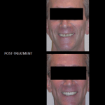Re-building his smile, through use of ceramic crowns and bridges.