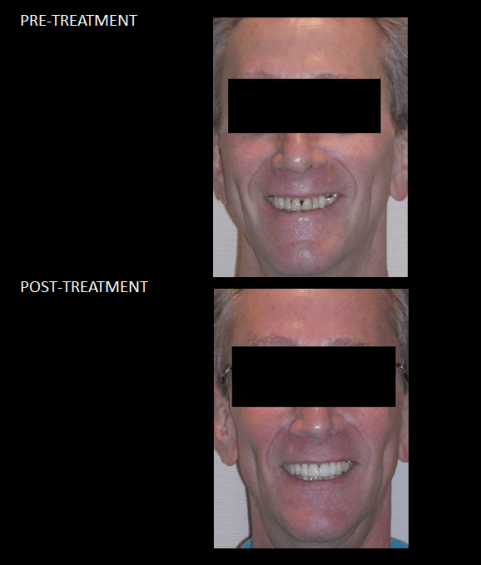 Re-building his smile, through use of ceramic crowns and bridges.