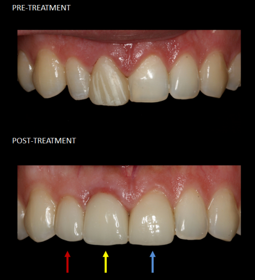 Restoration of front teeth with a crown