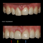 Restoration of front teeth with a crown
