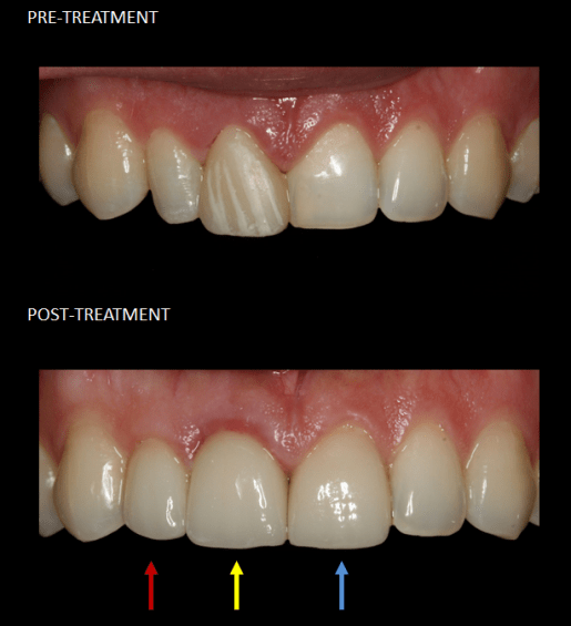 Restauración de dientes frontales con corona.