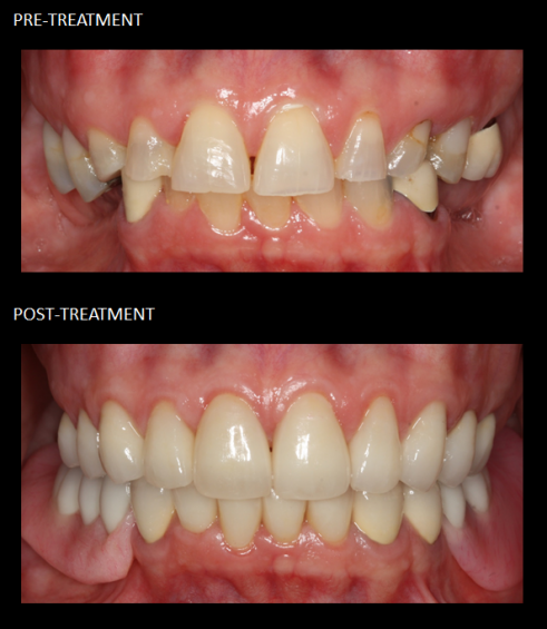 Full mouth reconstruction, with crowns and a lower implant-retained partial.