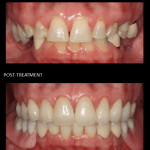 Full mouth reconstruction, with crowns and a lower implant-retained partial.