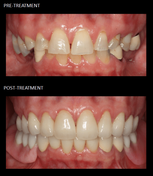 Full mouth reconstruction, with crowns and a lower implant-retained partial.