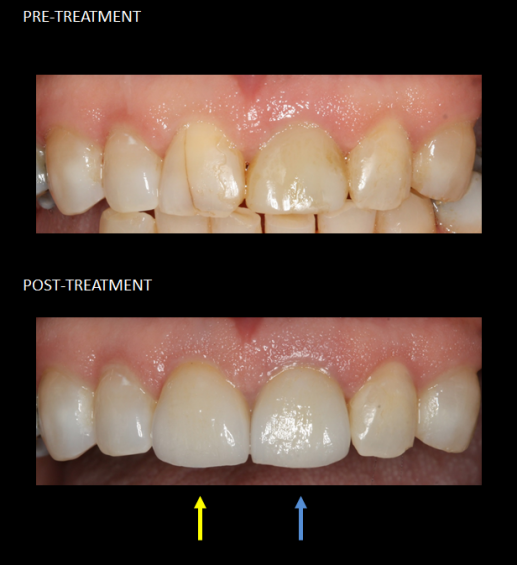 Restauración de los dientes frontales con un implante en el mismo día.