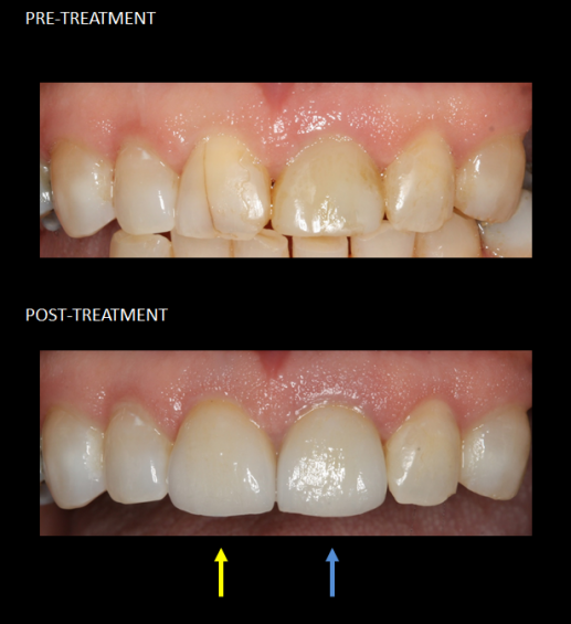 Restoration of front teeth with a same-day implant