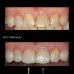 Restoration of front teeth with a same-day implant