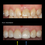 Restoration of front teeth with a same-day implant