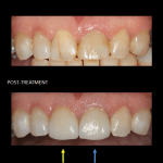 Restauración de los dientes frontales con un implante en el mismo día.
