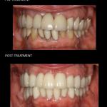 Reconstrucción bucal completa con coronas de cerámica sobre dientes e implantes..