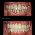 Full mouth reconstruction using ceramic crowns on teeth and implants.