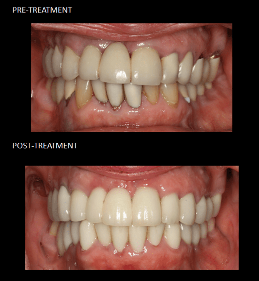 Full mouth reconstruction using ceramic crowns on teeth and implants.
