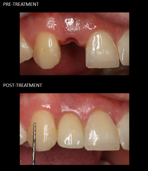 Single tooth implant placed on the day of extraction.