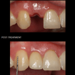 Single tooth implant placed on the day of extraction.