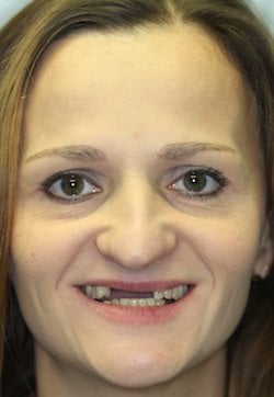 Full Mouth Rehabilitation before 