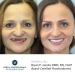 Implantes dentales de boca completa antes y después