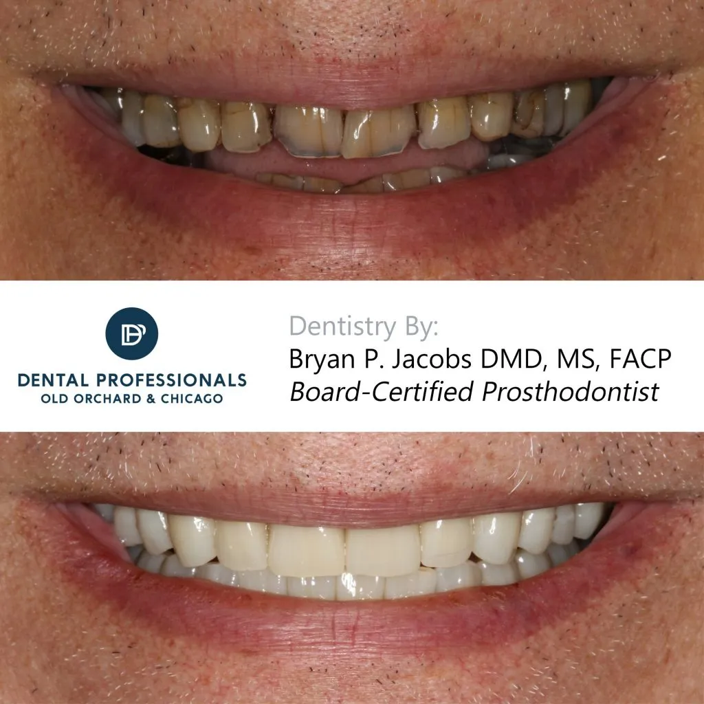 Full-Mouth-Rehabilitation case 1