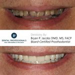 Full-Mouth-Rehabilitation case 1