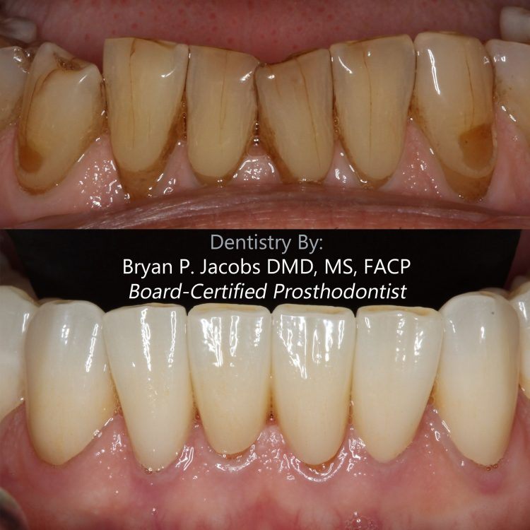 Full Mouth Rehabilitation, detail view of natural-appearing ceramics